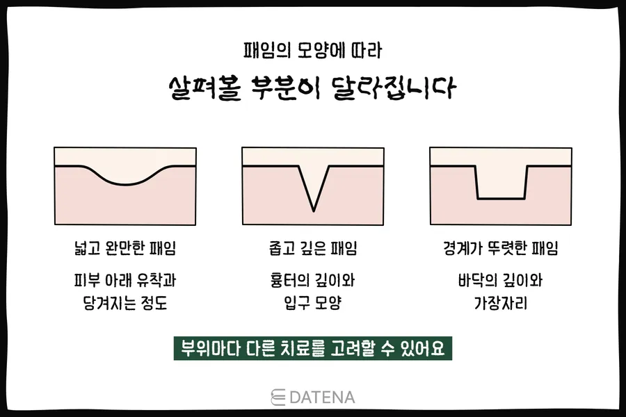 넓고 완만한 패임, 좁고 깊은 패임, 경계가 뚜렷한 패임을 피부 단면으로 비교한 그림