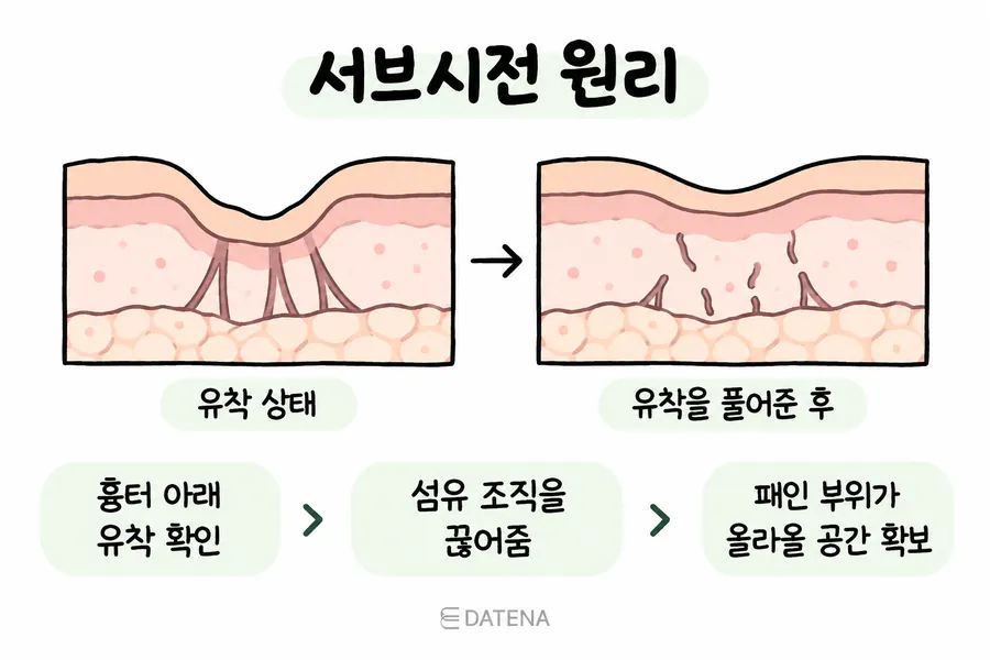 서브시전으로 패인 흉터 아래 유착 조직을 분리하는 원리 도식